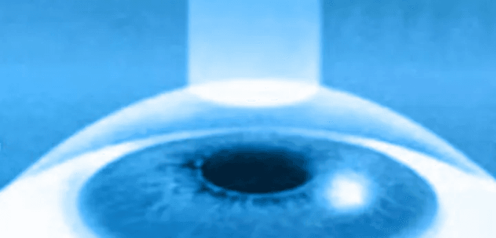 Refractive Surgery