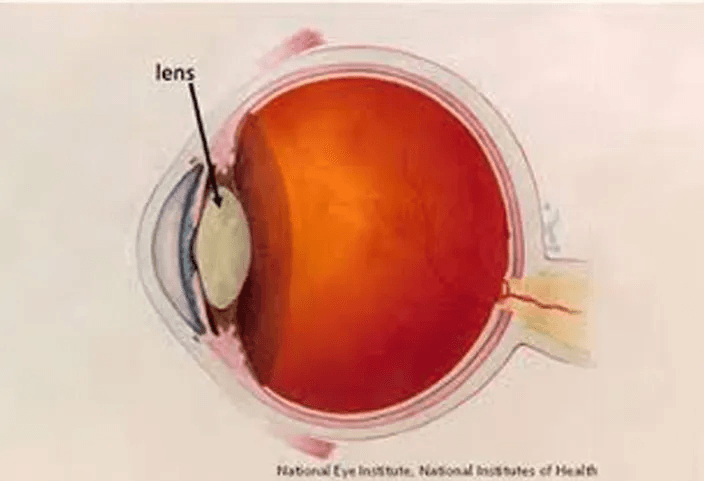 Cataract Treatment in Singapore