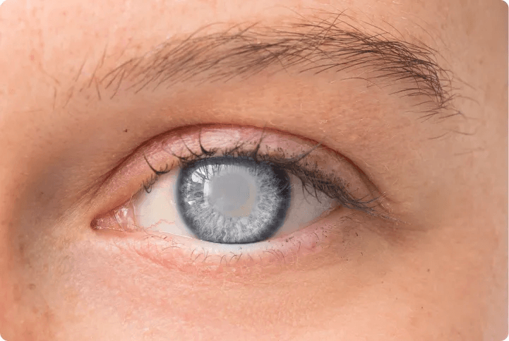 Glaucoma Condition
